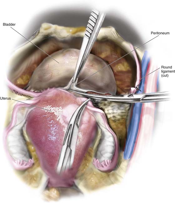 Abdominal Hysterectomy | Obgyn Key