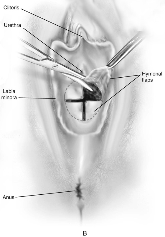 Congenital Vaginal Abnormalities