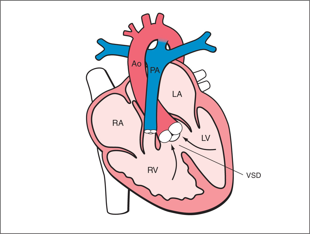 Tetralogy of Fallot, Pulmonary Atresia with Ventricular ...