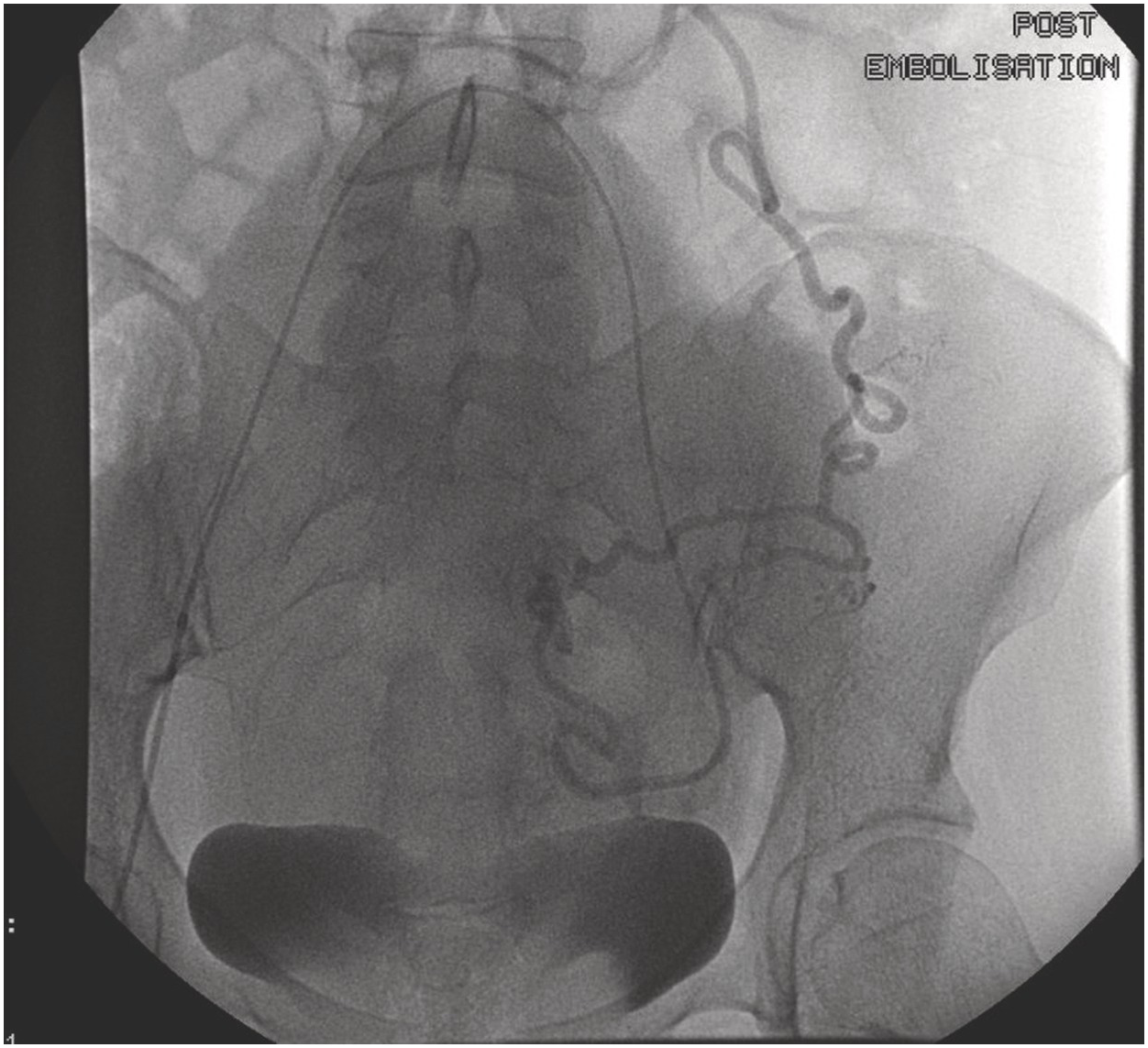 Chapter 18 – Embolization For The Management Of Uterine Fibroids