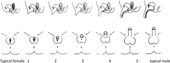 Chapter Differences In Sex Development Obgyn Key