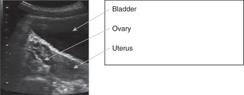 Chapter 6 – Polycystic Ovary Syndrome In Adolescence | Obgyn Key