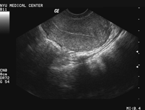 Abnormal Uterine Bleeding Obgyn Key 