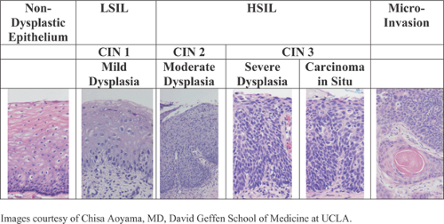 Human Papillomavirus And The Management Of The Abnormal Pap Test 