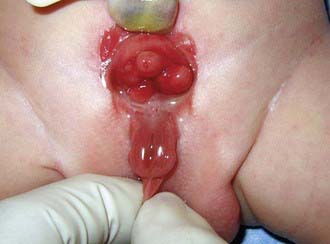 bladder exstrophy