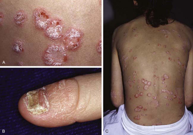 Diseases Of The Epidermis Obgyn Key