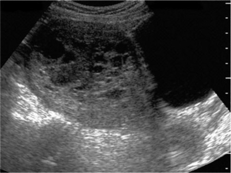 Gestational Trophoblastic Disease Molar Pregnancy Obgyn Key