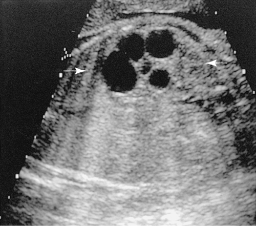 Fetal Abnormalities | Obgyn Key