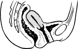 Prolapse And Urogynaecology Obgyn Key