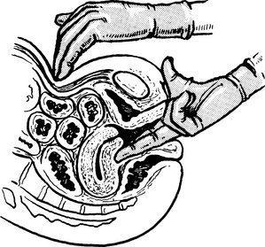 Prolapse And Urogynaecology Obgyn Key