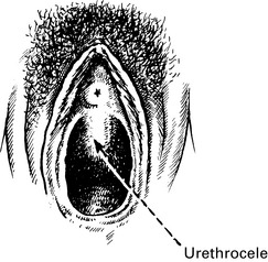 Prolapse And Urogynaecology Obgyn Key