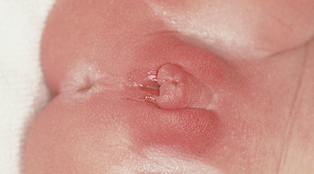 turner syndrome female genitalia