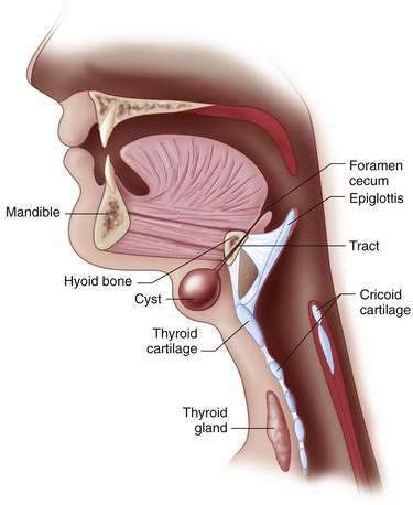 thyroglossal duct cyst anatomy