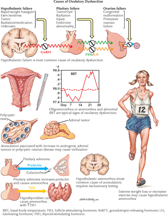 Amenorrhea: Secondary | Obgyn Key