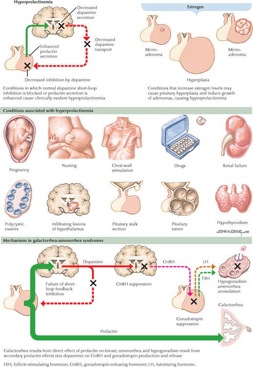 Hyperprolactinemia | Obgyn Key