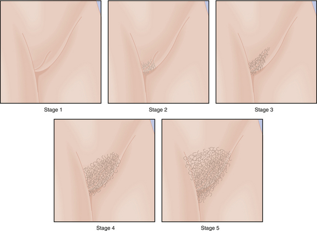 Stages of breast and pubic hair development. Stage 1 is