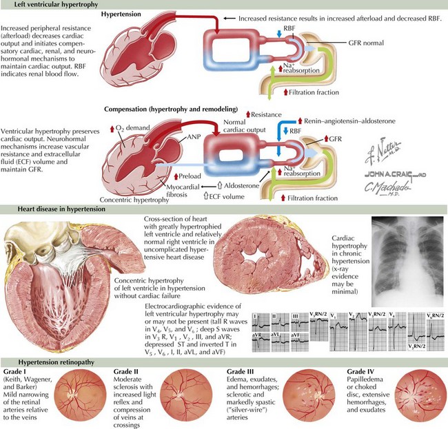 clinical presentation in hypertension