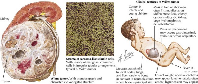 Renal Neoplasms Obgyn Key