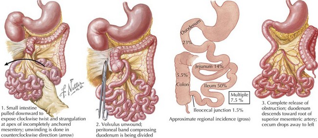 Intestinal Obstruction and Malrotation | Obgyn Key diagram of cecal volvulus 