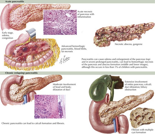 Disorders Of The Pancreas Obgyn Key