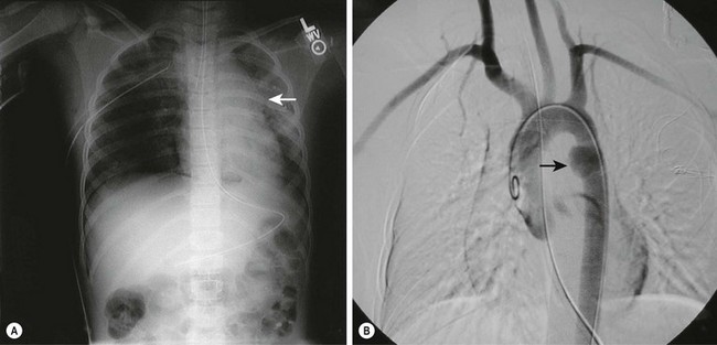 Thoracic Trauma | Obgyn Key