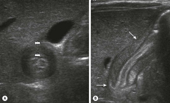 pyloric stenosis ultrasound