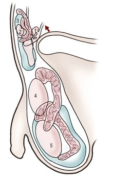 Undescended Testes and Testicular Tumors Obgyn Key