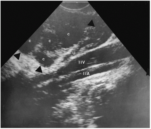 Point Of Care Sonography In Gynecology And Reproductive Medicine Obgyn Key 