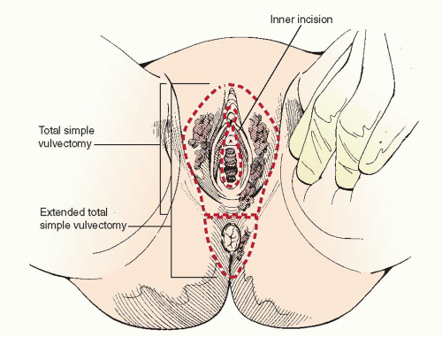 vulvectomy anterior