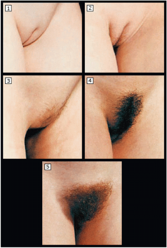 Stages of development in pubic hair in girls. 