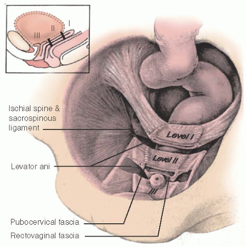 Vaginal Vault Prolapse Obgyn Key