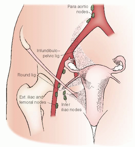 Endometrial cancer of the lymph nodes
