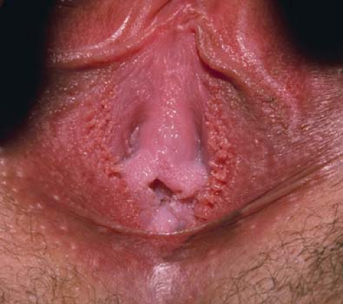 Vestibular papillomatosis cause itching - Vestibular papillomatosis how to remove - pestideacvariu.ro