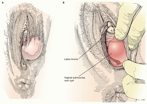 Office Management of Bartholin Gland Cysts and Abscesses