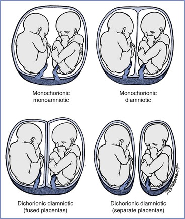 Abnormal Presentation And Multiple Gestation | Obgyn Key