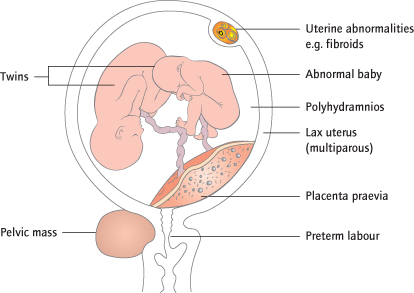 What happens when my baby is in transverse lie?