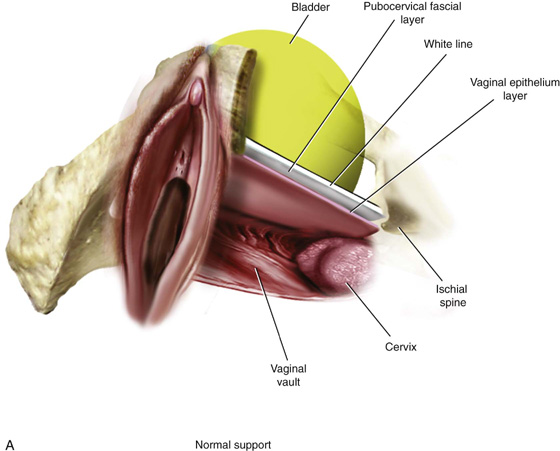 Anterior vaginal prolapse (cystocele) - Diagnosis and treatment - Mayo  Clinic