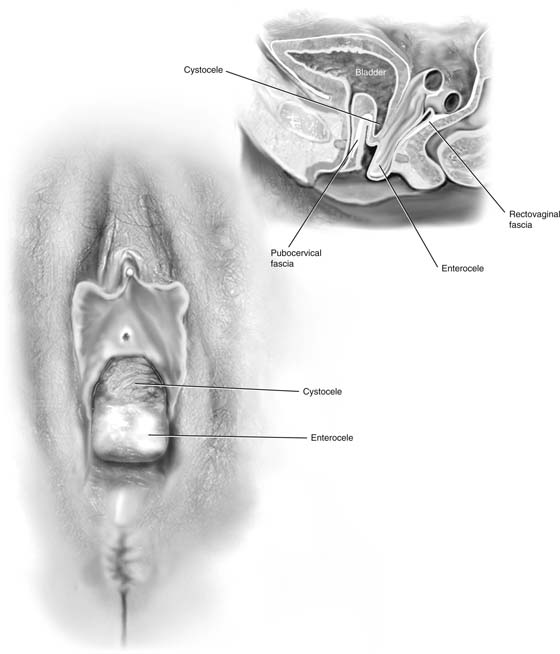 Vaginal Repair Of Cystocele Rectocele And Enterocele