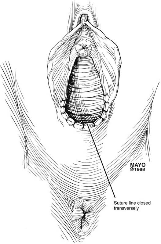 Iatrogenic Vaginal Constriction Obgyn Key