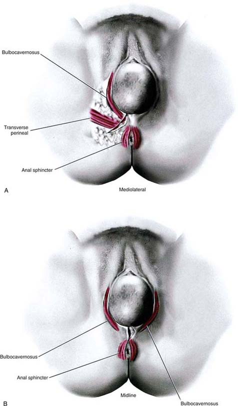 Episiotomy Obgyn Key