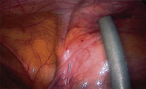 inferior epigastric artery laparoscopy