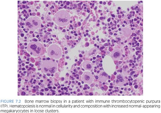 Idiopathic Thrombocytopenic Purpura Bone Marrow Findings