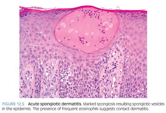 allergic contact dermatitis histology