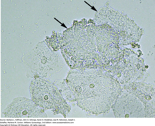 Clue Cells On Wet Prep 5485