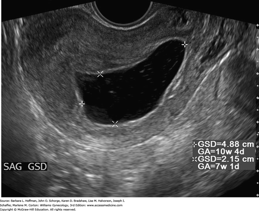 CHAPTER 6: First-Trimester Abortion | Obgyn Key