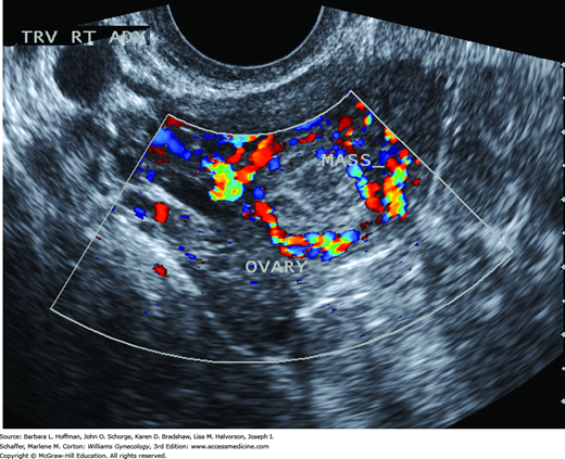 Doppler in Benign and Malignant Conditions of the Ovary | SpringerLink