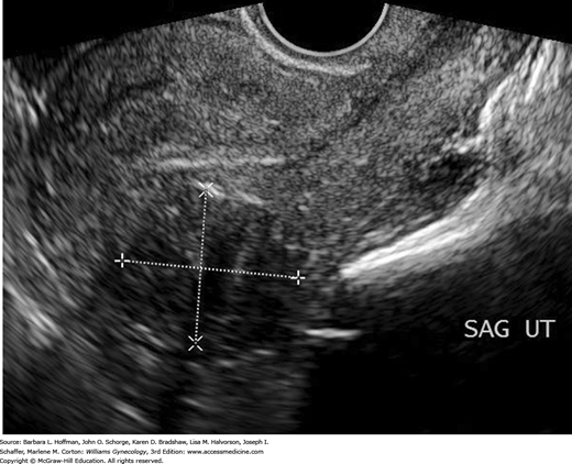 CHAPTER 9: Pelvic Mass | Obgyn Key