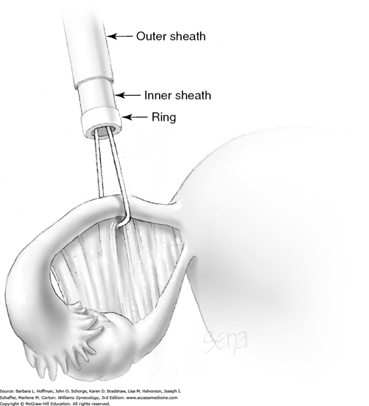 Sterilization - Obstetrics and Gynecology 7 Ed.