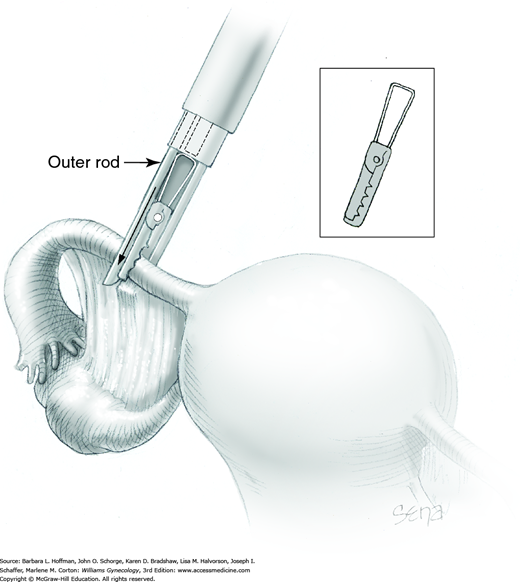 CHAPTER 44: Minimally Invasive Surgery | Obgyn Key