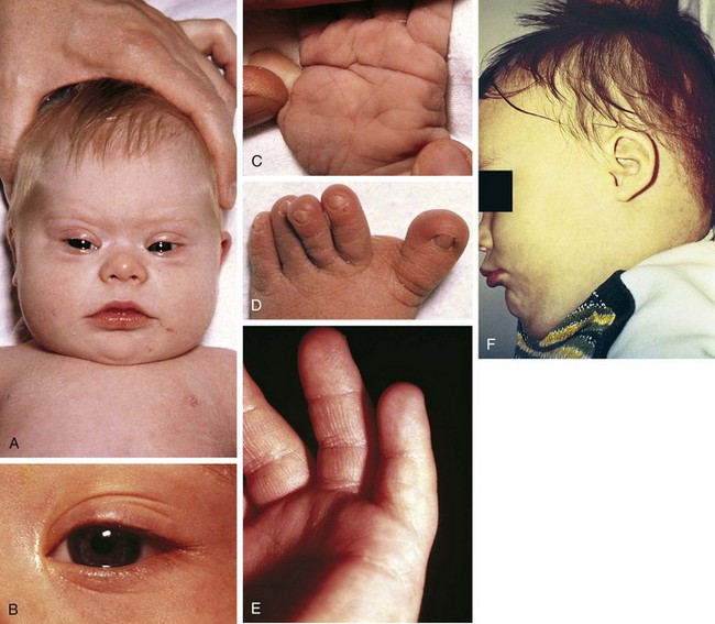 Genetic Disorders and Dysmorphic Conditions | Obgyn Key